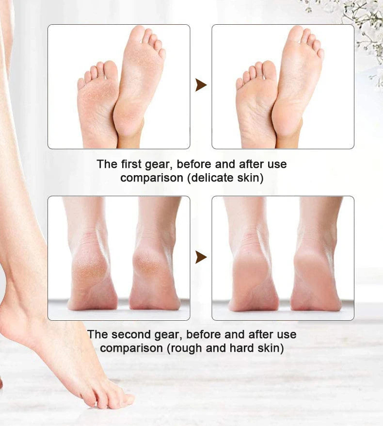 Electric Callus Remover for Feet